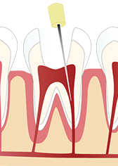 根管治療