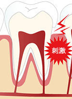 冷たいものや熱いものがしみるが、すぐに痛みが消える