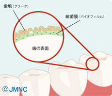 歯垢（プラーク）細菌膜（バイオフィルム）歯の表面