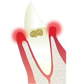 第1段階 歯肉炎
