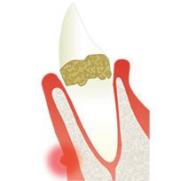 歯根の先端付近が腫れている