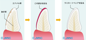 ラミネートベニア