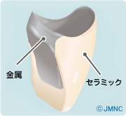 メタルボンド